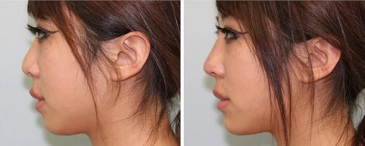 Коррекция носа: изменение и уменьшение