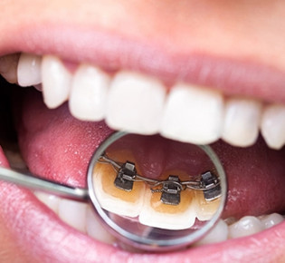 Как исправляют прикус в стоматологических клиниках?