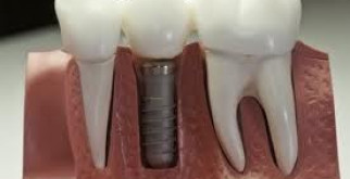 Достоинства зубных имплантатов