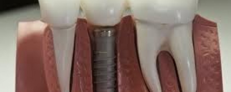 Достоинства зубных имплантатов