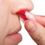 Как остановить носовое кровотечение